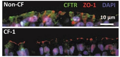 Top panel: Immunofluorescence showing expression and localization of WT-CFTR (green) on primary nasal tissue obtained from a non-CF family member. Tight junction protein ZO-1 (red) and nuclei (DAPI, blue) are also labeled. Bottom panel: Expression and localization of ΔI1234_R1239-CFTR (green) from a family member with CF (i.e. Patient CF-1).